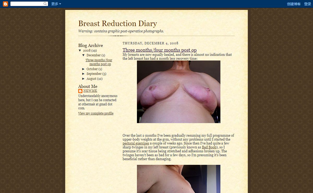 Breast Reduction Diary
