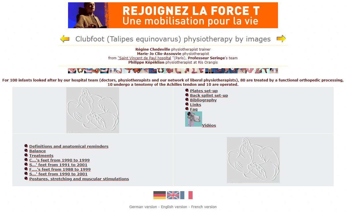 Clubfoot (Talipes equinovarus) physiotherapy by images