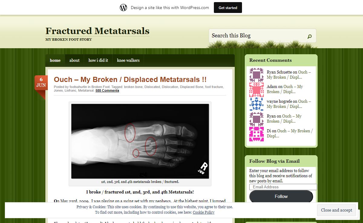 Fractured Metatarsals | My Broken Foot Story