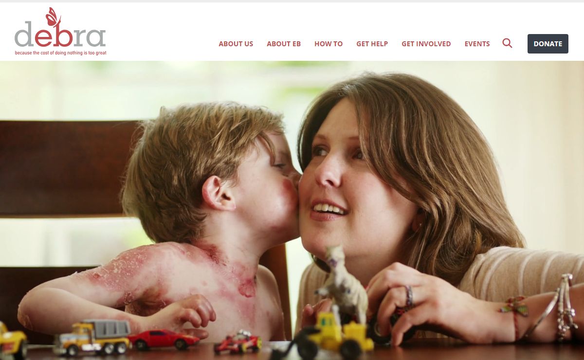 Support Epidermolysis Bullosa Patients | Programs, Advocacy & Research